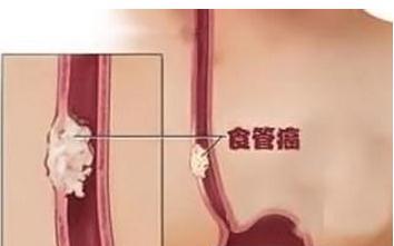 福州去哪中医治食管癌