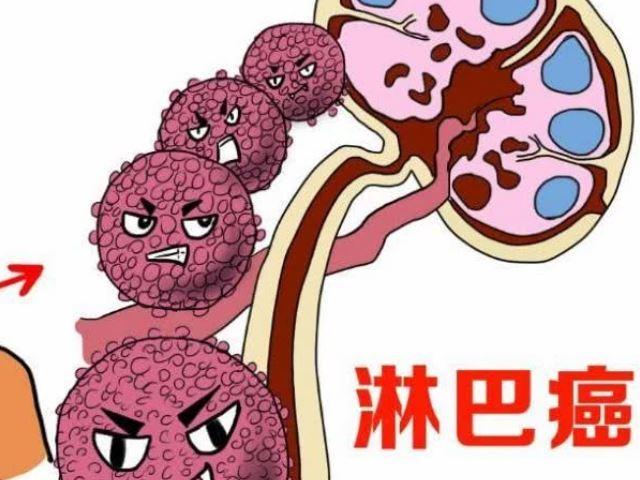 福州中医治疗淋巴癌的肺转移