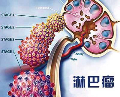 福州御和堂：早期淋巴癌隐藏类似感冒