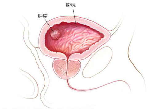 福州中医肿瘤：膀胱癌的表现是什么