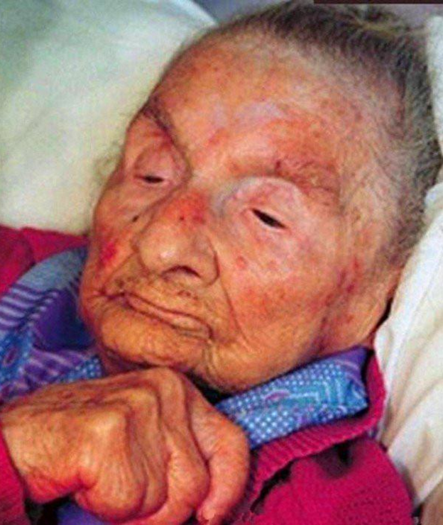 中医治疗肝癌