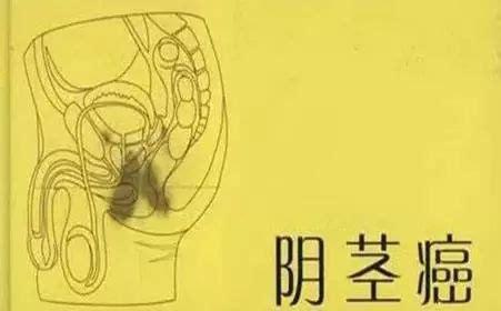 治疗阴茎癌要多少钱
