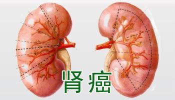 肾癌的早期的症状及预防方法