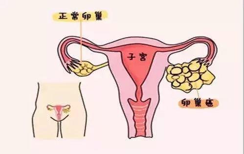 卵巢囊的常见的症状