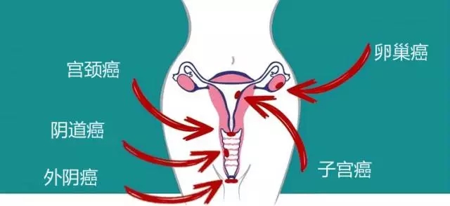 女性外阴癌通常有四种早期症状