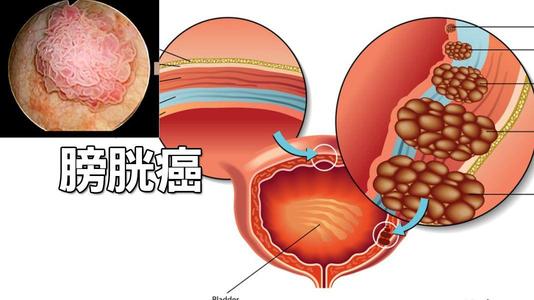 膀胱癌病因有哪些