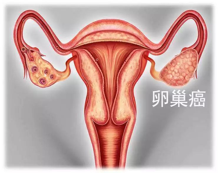 诱发卵巢癌的原因有哪些？福州御和堂老中医讲解