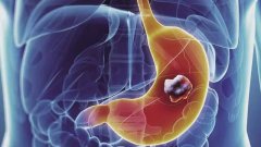 为何会出现胃癌？出现胃癌可能是这四个原因在作祟